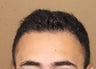 FUE /Neograft hair transplant