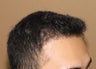 FUE Nograft hair transplantation