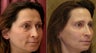 Eyelid surgery or blepharoplasty
