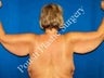Arm Lift, Massive Weight Loss