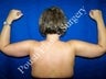 Arm Lift, Massive Weight Loss