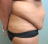 Abdominoplasty with Liposuction to the Flanks