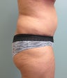 Abdominoplasty with Liposuction to the Flanks