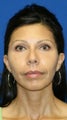 Facelift, Fat Transfer, Upper Bleph, Lower Bleph, & Lower Eyelid Skin Pinch