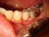 Crown placement on dental implant