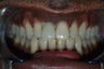 Trauma case. Implant to replace an avulsed tooth
