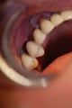 Bridge failure and subsequent implant fixed bridge treatment