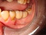 Molar replacement with 2 implants