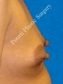 Nipple-areola repair
