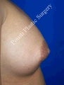 Nipple-areola repair