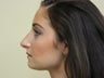 Rhinoplasty