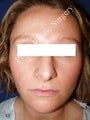Rhinoplasty 