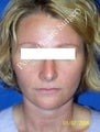 Rhinoplasty 