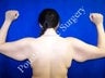 Arm Lift 