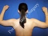 Arm Lift 
