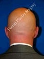 Ear Surgery (Otoplasty)
