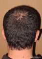 FUE hair transplant donor site - no scar technique