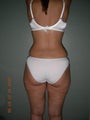 Vaser Liposuction