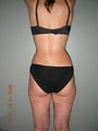 Vaser Liposuction