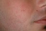 Acne treatment with Accutane