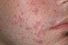 Acne treatment with Accutane