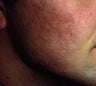 Acne Scars Treatment