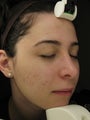 Acne Scarring