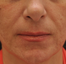 Acne Scarring