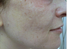 Acne Scars Treatment