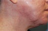 Acne Scar Treatment with Surgical Excisions and Geometric Line Closures.