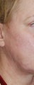 Before and After Multiple Excisions, Fat Grafting and Co2 Laser Active Fx Resurfacing Acne Scar Treatment