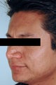 Brown Acne Scars in Santa Ana, CA.  Remove Acne Scars with Lasers.