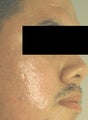Acne Scar Treatment