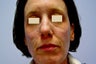 Fraxel Restore Treatment of Acne Scarring