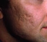 Acne Scars Treatment