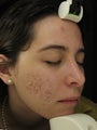 Acne Scarring
