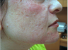Acne Scars Treatment
