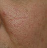 Before and After Subcision and TCA CROSS (Chemical Reconstruction of Skin Scars) Method of the Right Cheek