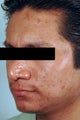 Brown Acne Scars in Santa Ana, CA.  Remove Acne Scars with Lasers.