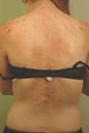 Laser Back Acne Treatment