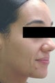 Acne Laser Treatment