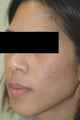Acne Treatment