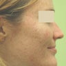 Acne Laser Treatment
