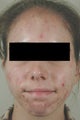 Acne Laser Treatment