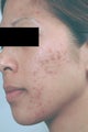 Acne Treatment