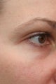 Pelleve to eyelids in a 39 year old woman