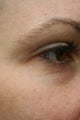 Pelleve to eyelids in a 39 year old woman