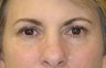 Active FX Laser Resurfacing