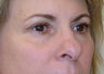 Active & Deep FX Laser Resurfacing