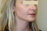 Active FX Laser Resurfacing